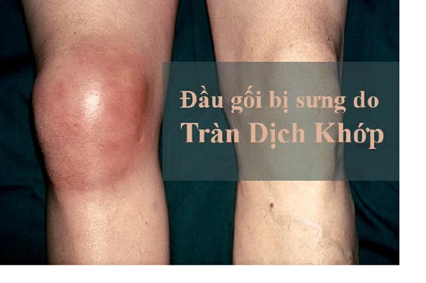 Trung tâm Y tế thành phố Yên Bái triển khai ngày vi chất dinh dưỡng kết hợp với tẩy giun đợt I năm 2019