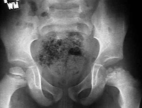 Phụ huynh nên cho trẻ từ 5 đến dưới 12 tuổi tiêm vaccine