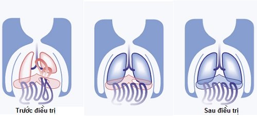 Hình ảnh tin tức Hay ăn gỏi cá, giun rồng ký sinh trong đùi người đàn ông