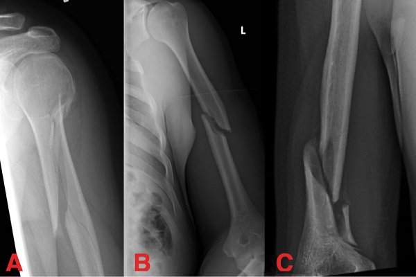 Hưởng ứng ngày thính lực quốc tế 03/3: Chăm sóc thính giác, phòng mất thính lực