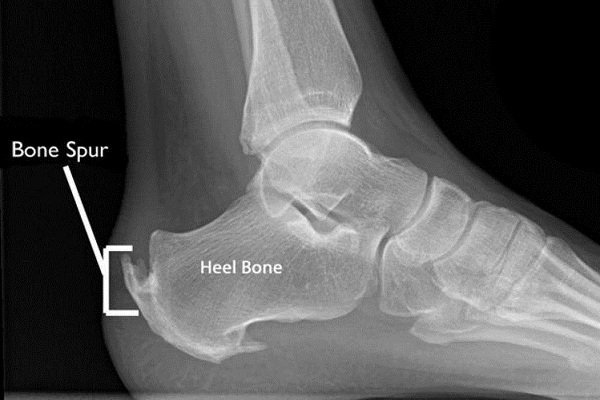 HƯỚNG DẪN NGƯỜI ĐƯỢC TIÊM CHỦNG TỰ THEO DÕI SAU TIÊM CHỦNG VẮC-XIN COVID-19